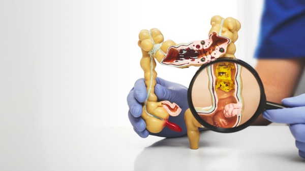 Uzmanından kalın bağırsak kanseri mesajı: Düzenli tarama hayat kurtarır!