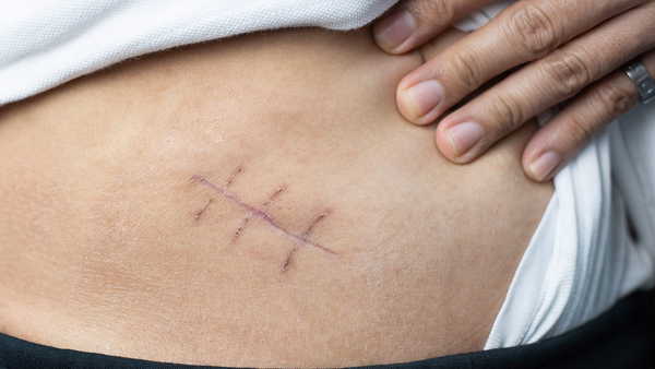 Neşter izine son: Kadın hastalıklarında ‘V-NOTES’ ile aynı gün taburcu dönemi!